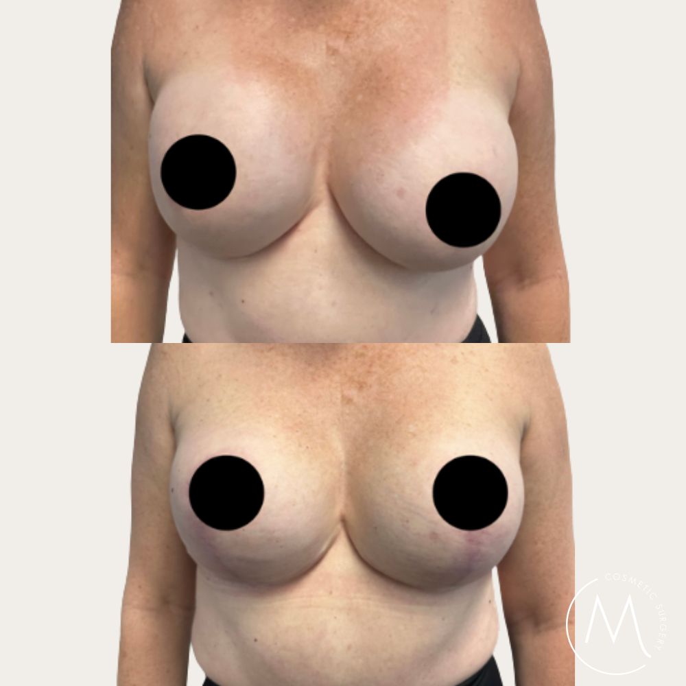 Before and after picture of Breast Revision and lift patient