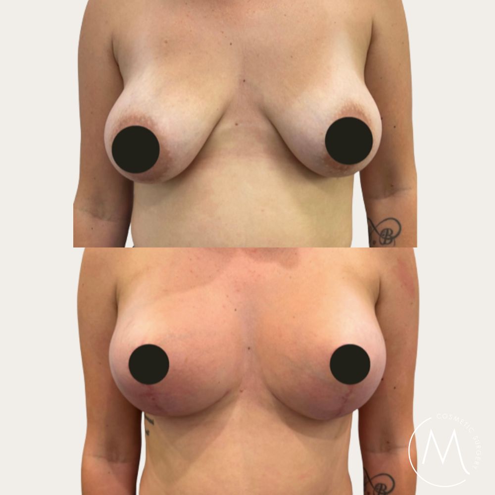 Before and after picture of Breast Lift & Augmentation patient