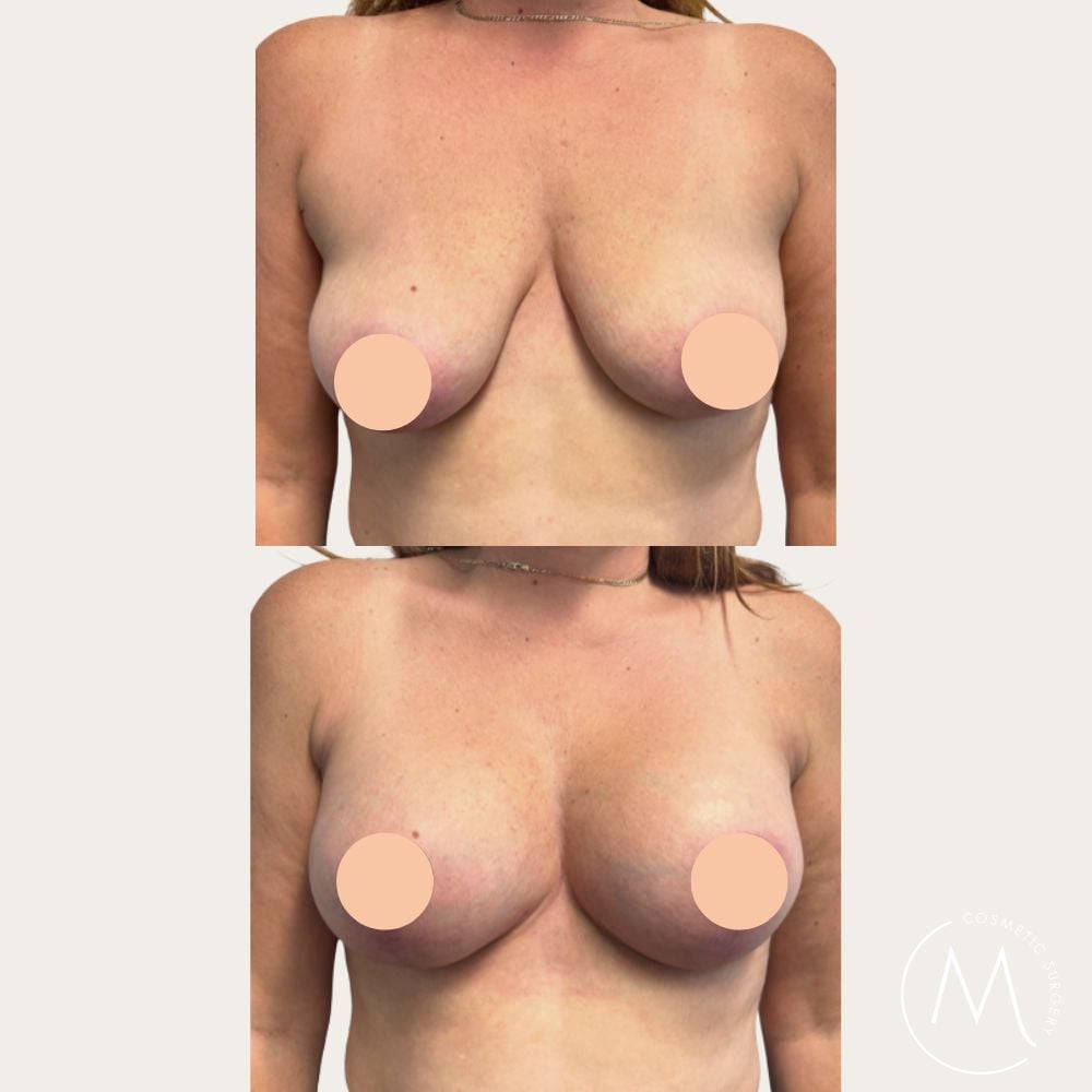 Before and after picture of breast lift and augmentation patient