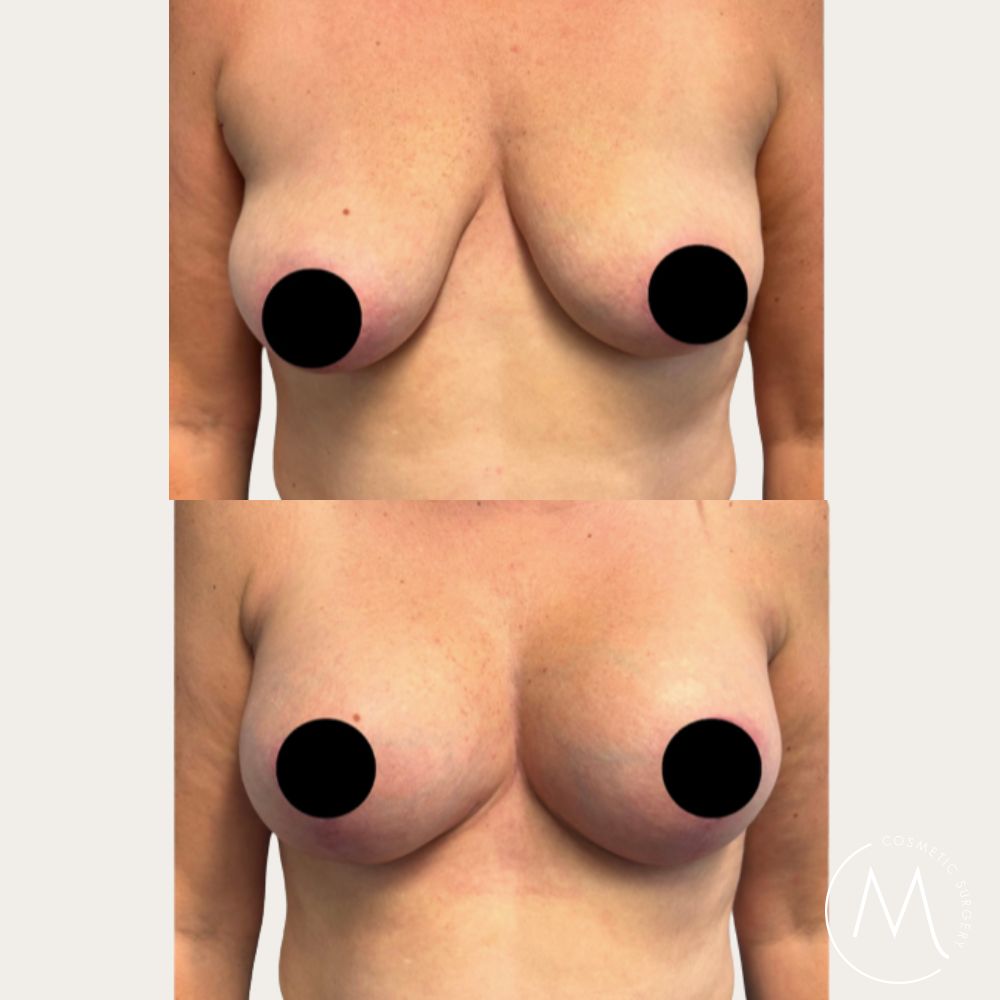 Before and after picture of Breast Lift & Augmentation patient