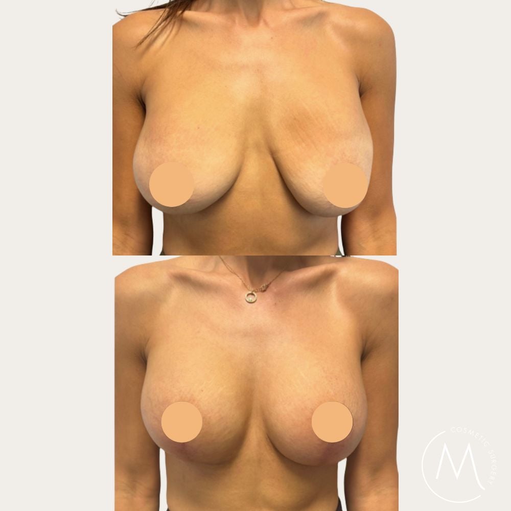 Before and after picture of Breast Lift & Augmentation patient