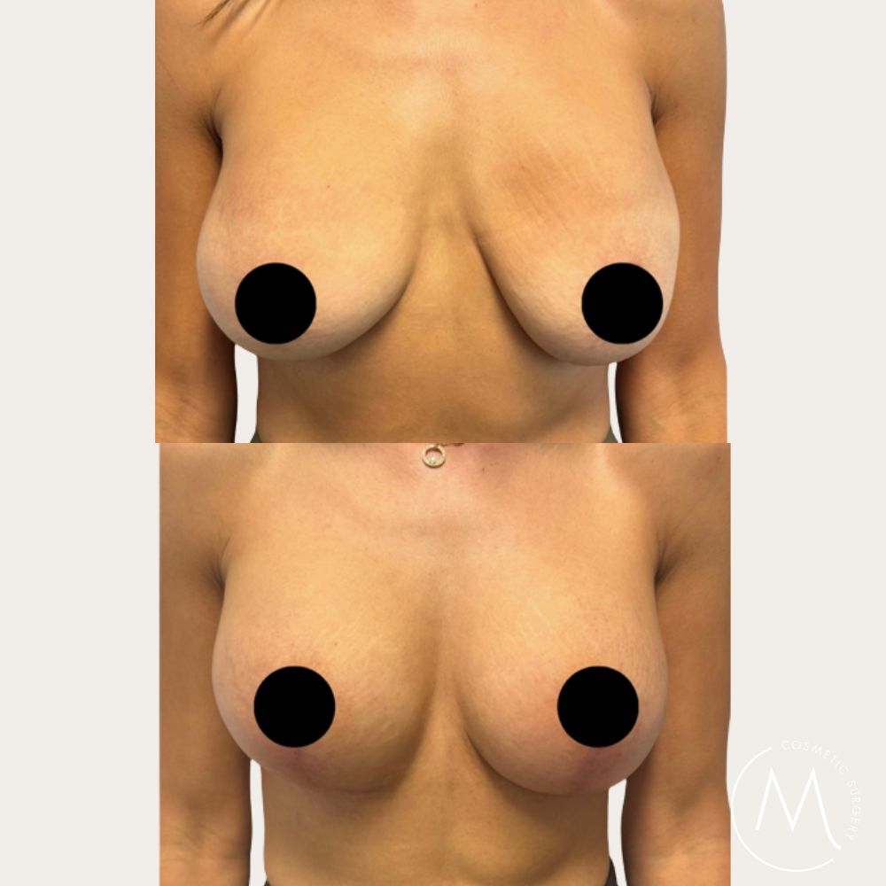 Before and after picture of Breast Lift & Augmentation patient