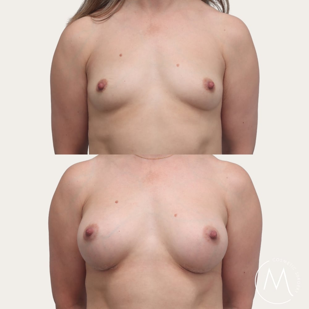 Before and after picture of breast augmentation patient