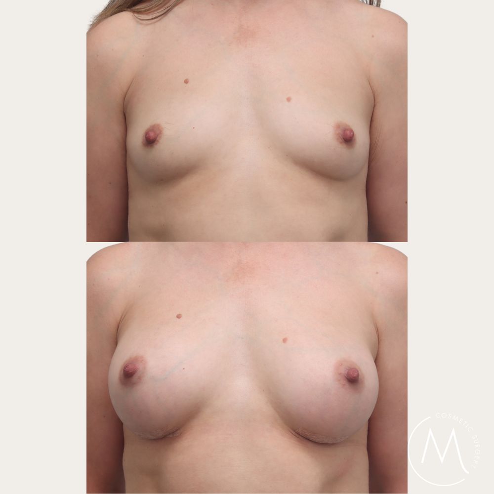 Before and after picture of breast augmentation patient