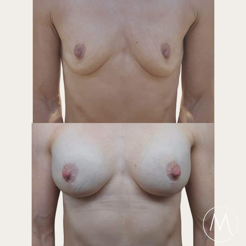 Before and after picture of Breast revision patient
