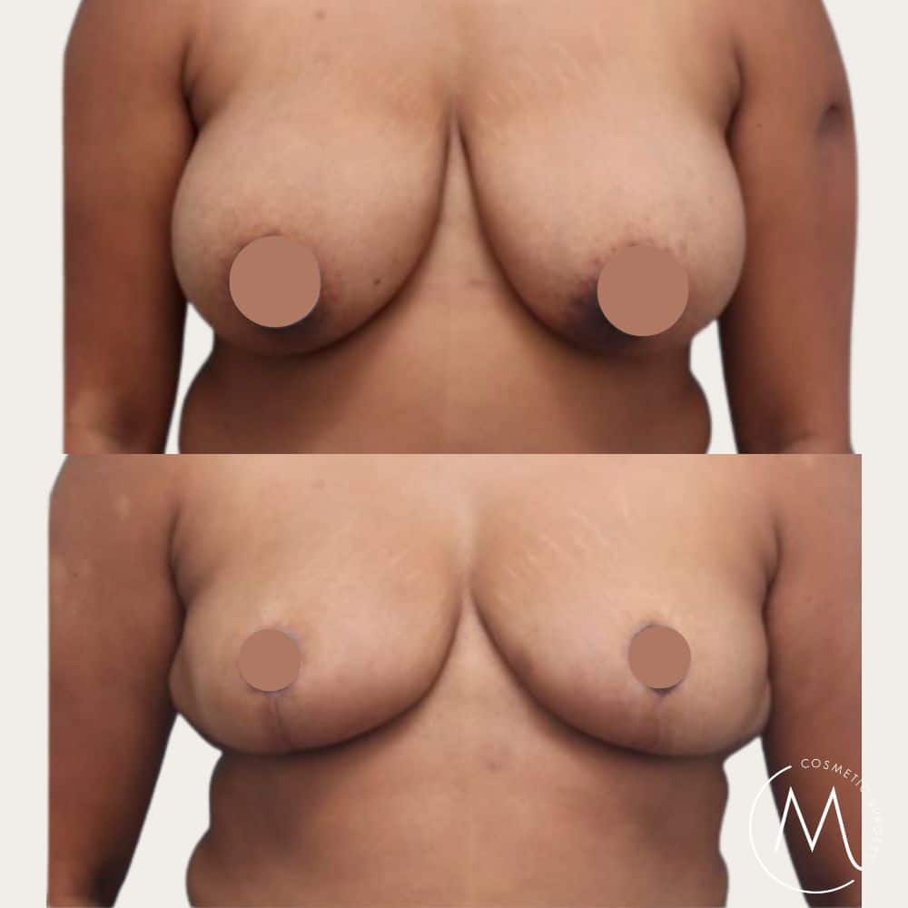 Before and after picture of breast reduction patient