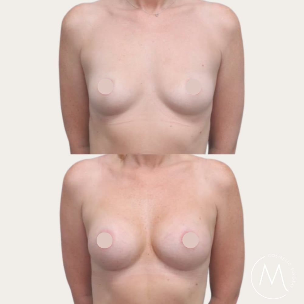 Before and after picture of breast augmentation patient