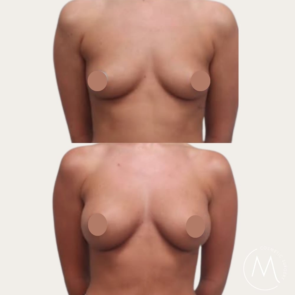 Before and after picture of breast augmentation patient
