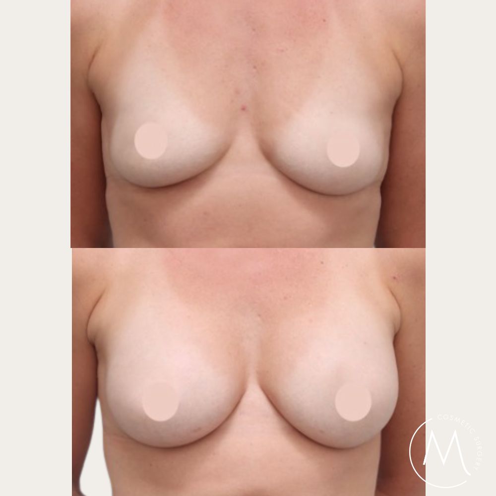 Before and after picture of breast augmentation + Fat Transfer patient