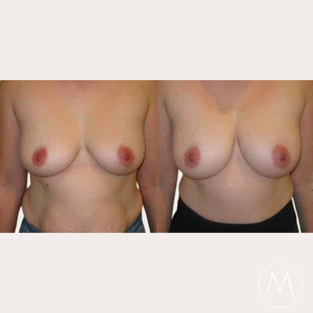 Before and after picture of breast Fat Transfer patient