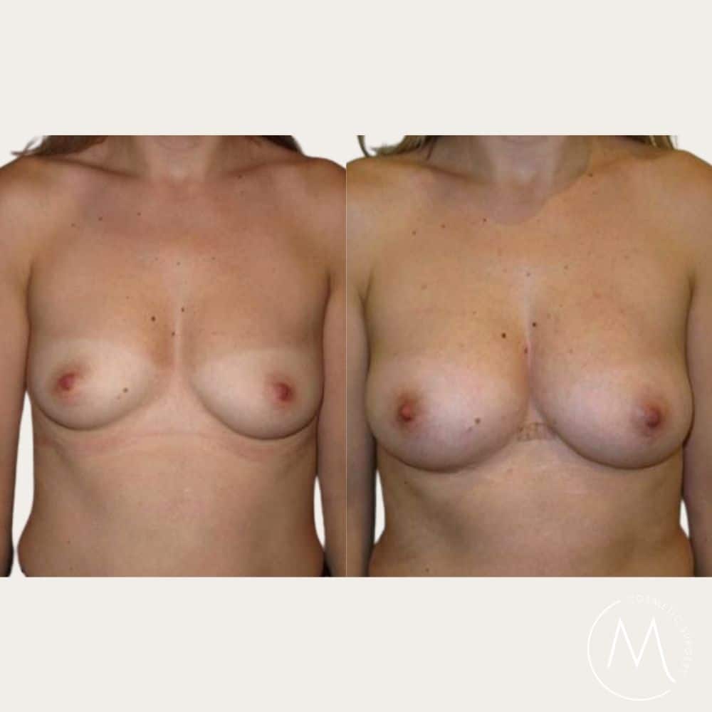 Before and after picture of breast Fat Transfer patient