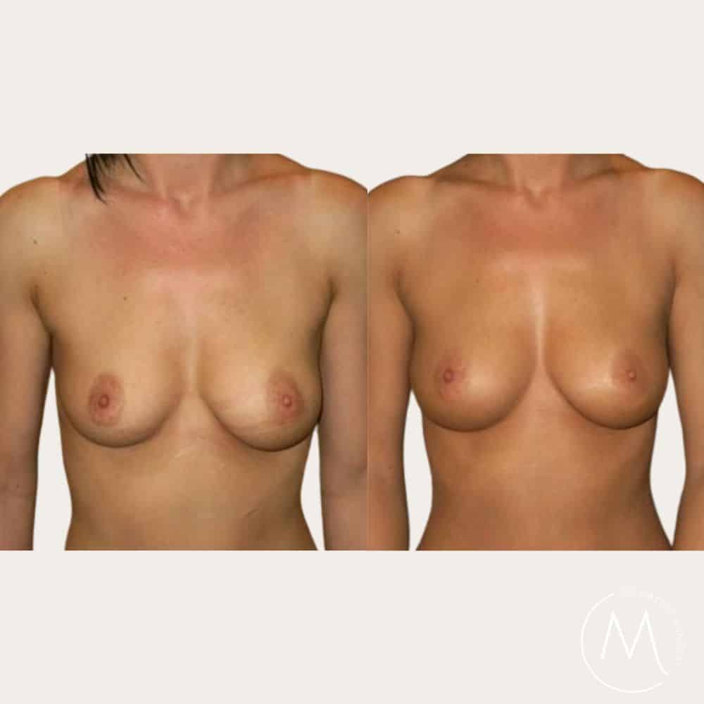 Before and after picture of breast Fat Transfer patient