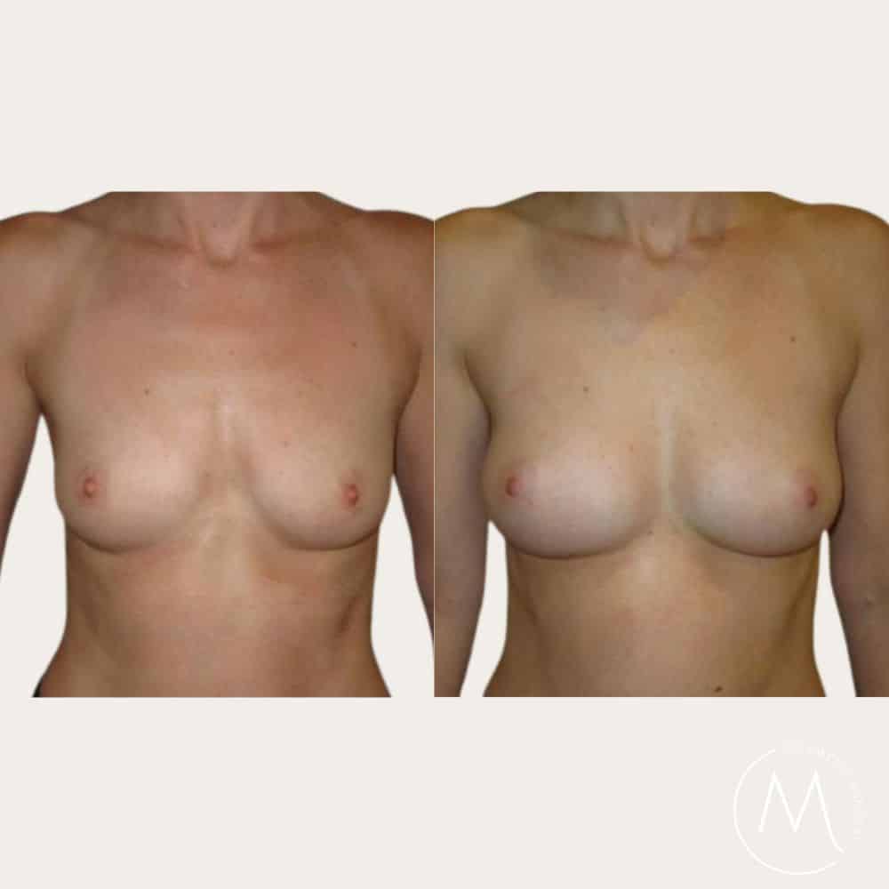 Before and after picture of breast Fat Transfer patient