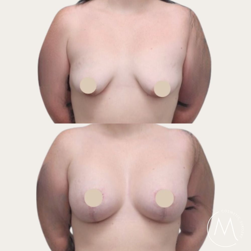 Before and after picture of breast lift and augmentation patient