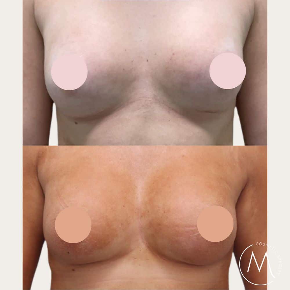 Before and after picture of breast revision patient