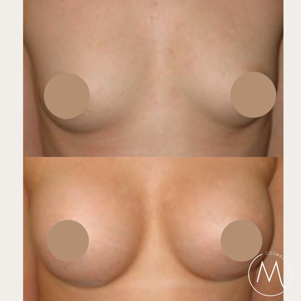 Before and after picture of breast augmentation patient