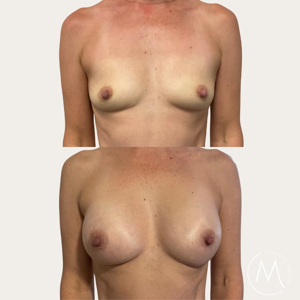 Before and after picture of breast augmentation patient