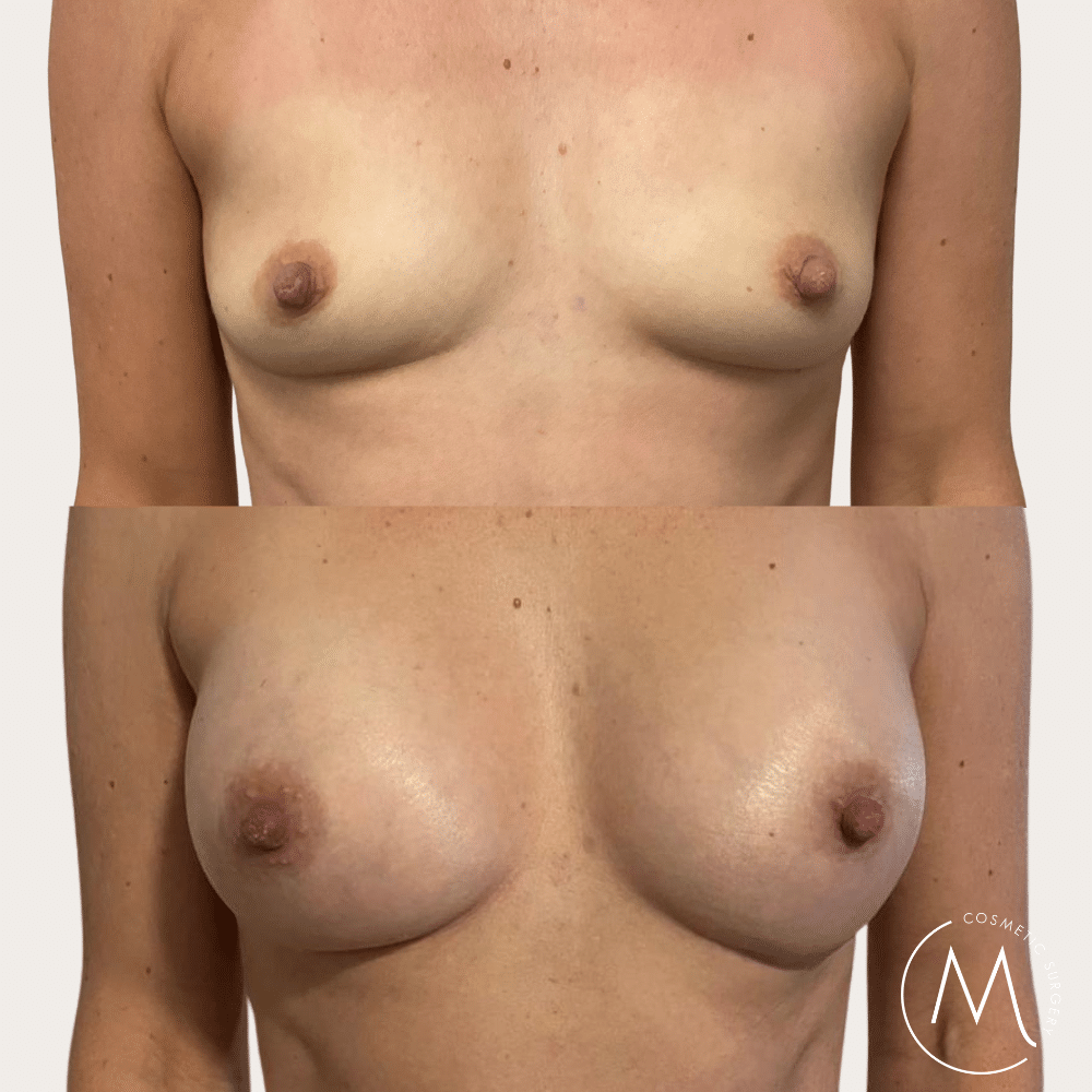 Before and after picture of breast augmentation patient
