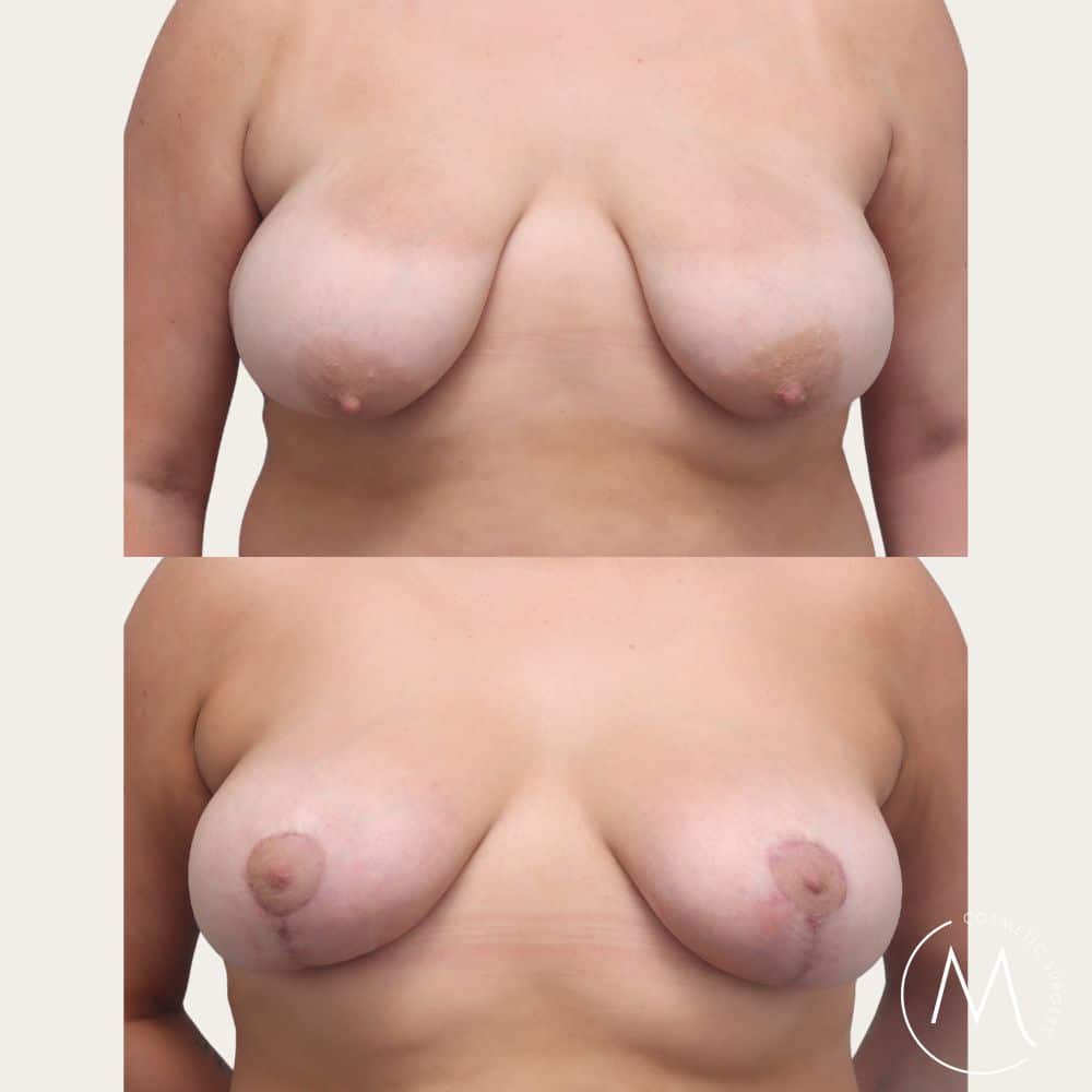 Before and after picture of Breast Lift patient