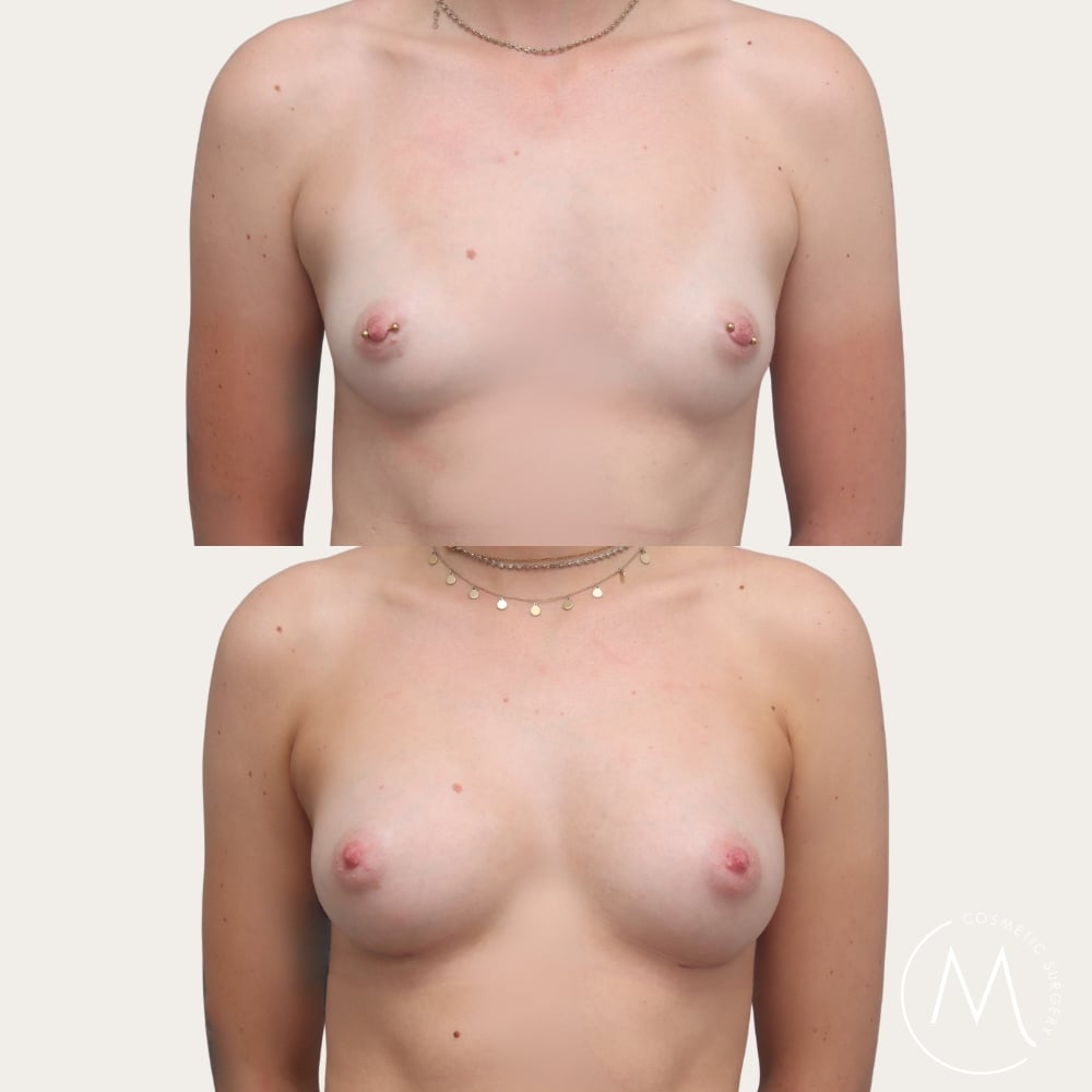 Before and after picture of breast augmentation patient