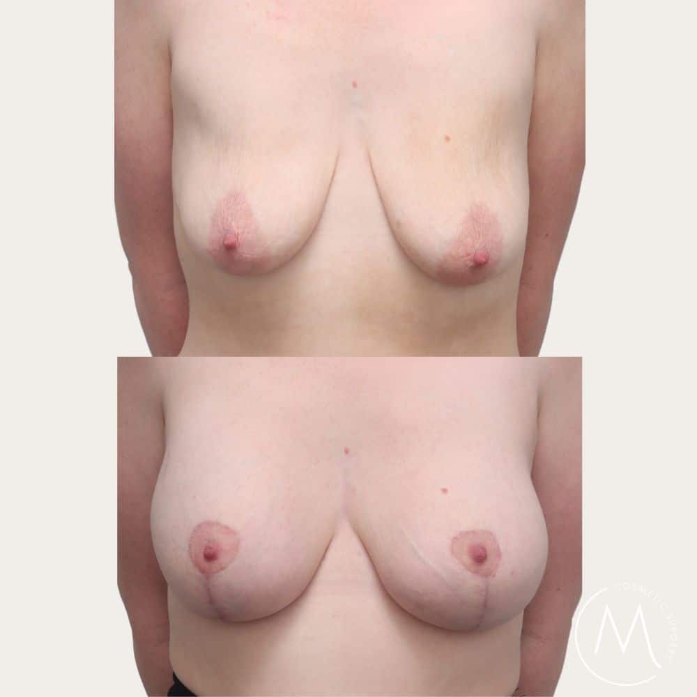 Before and after picture of Breast Lift & Augmentation patient