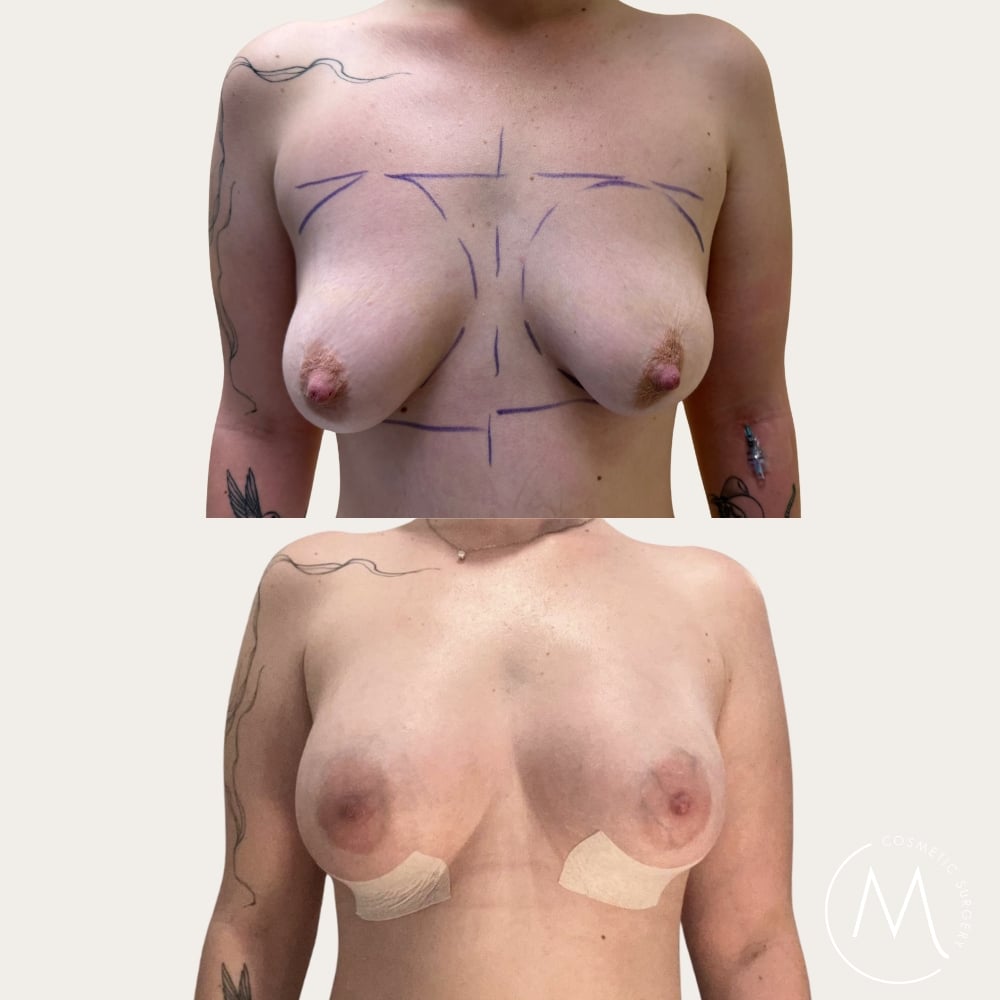 Before and after picture of breast augmentation patient