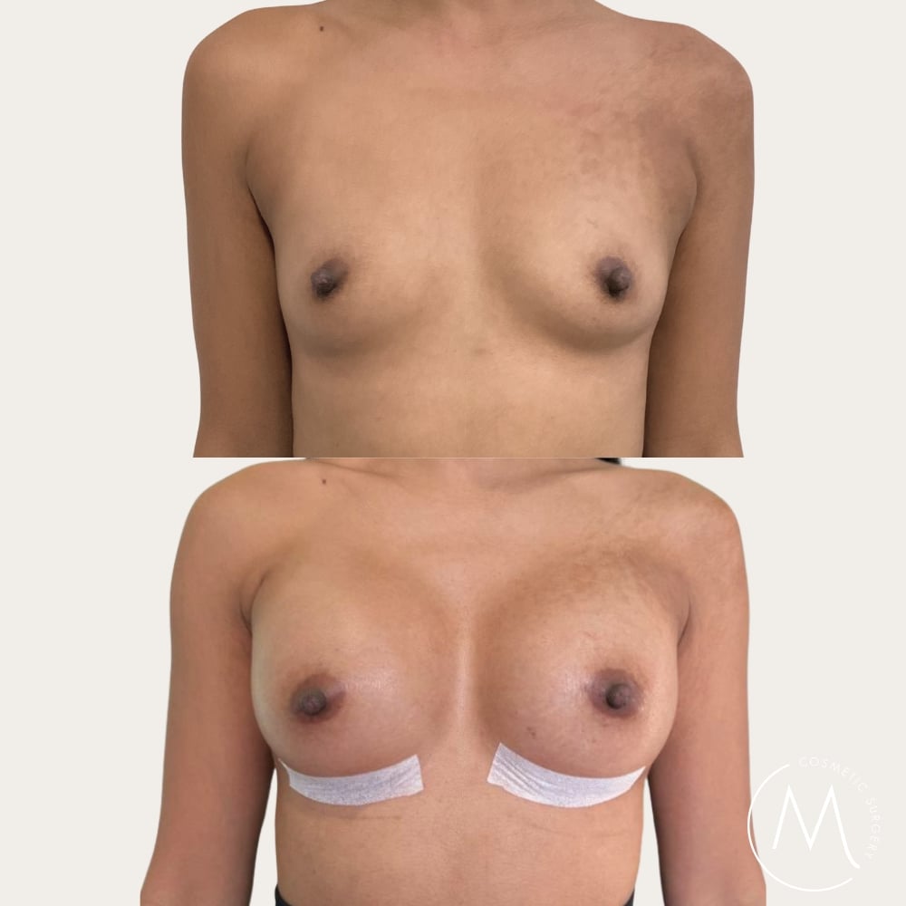 Before and after picture of breast augmentation patient