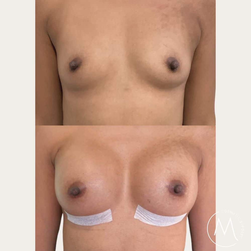 Before and after picture of breast augmentation patient