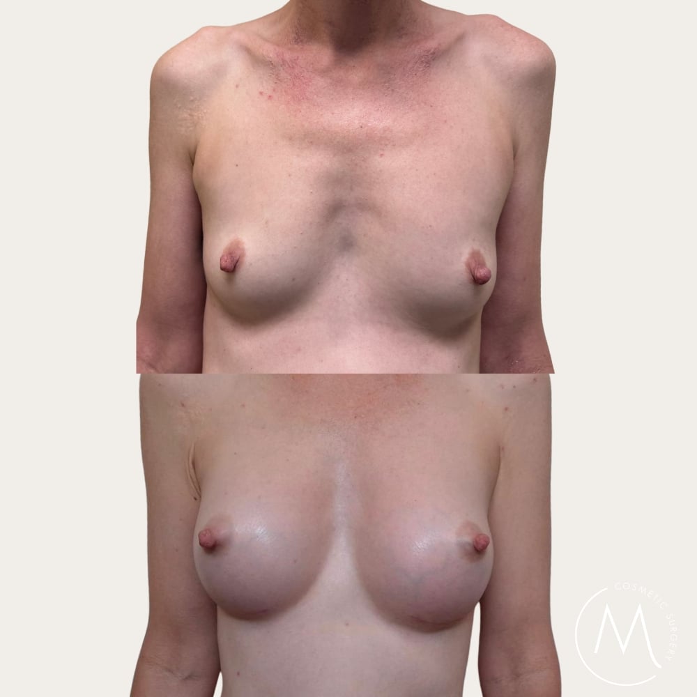 Before and after picture of breast augmentation patient