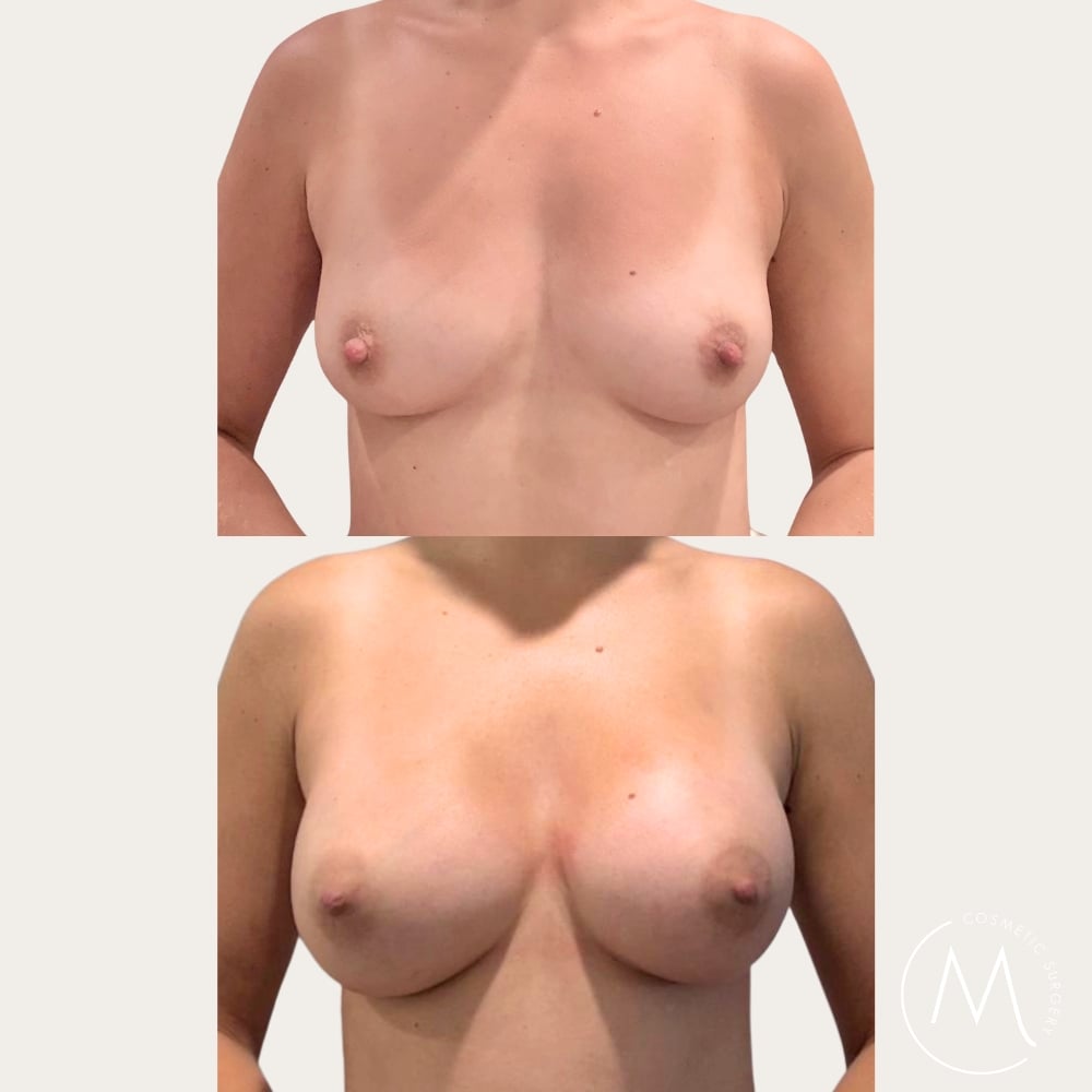 Before and after picture of breast augmentation patient
