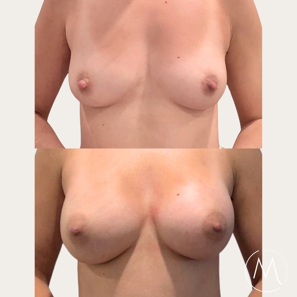 Before and after picture of breast augmentation patient