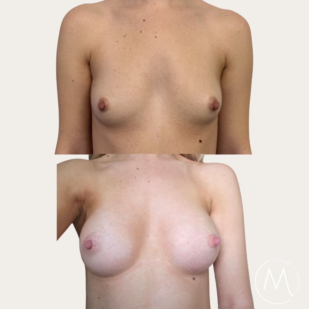 Before and after picture of breast augmentation patient