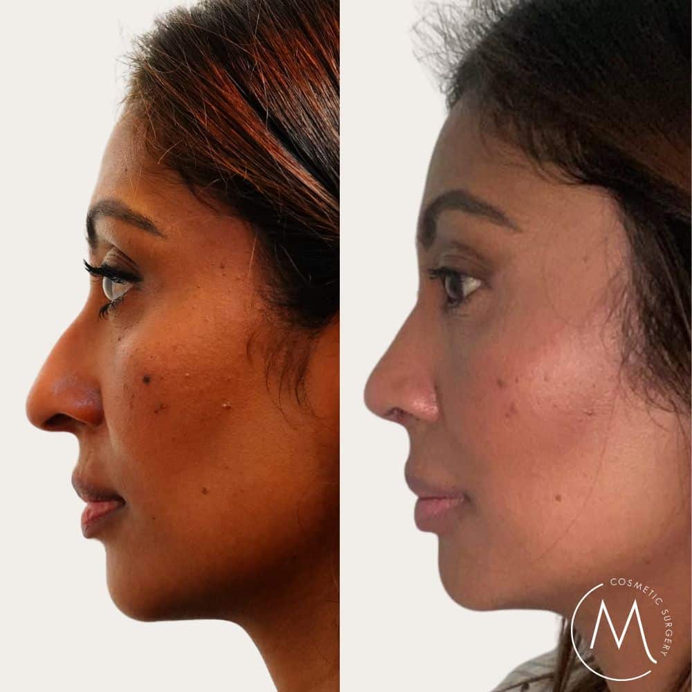 Before and after picture of rhinoplasty patient