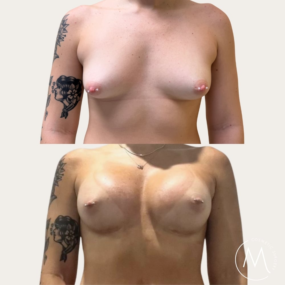 Before and after picture of breast augmentation patient