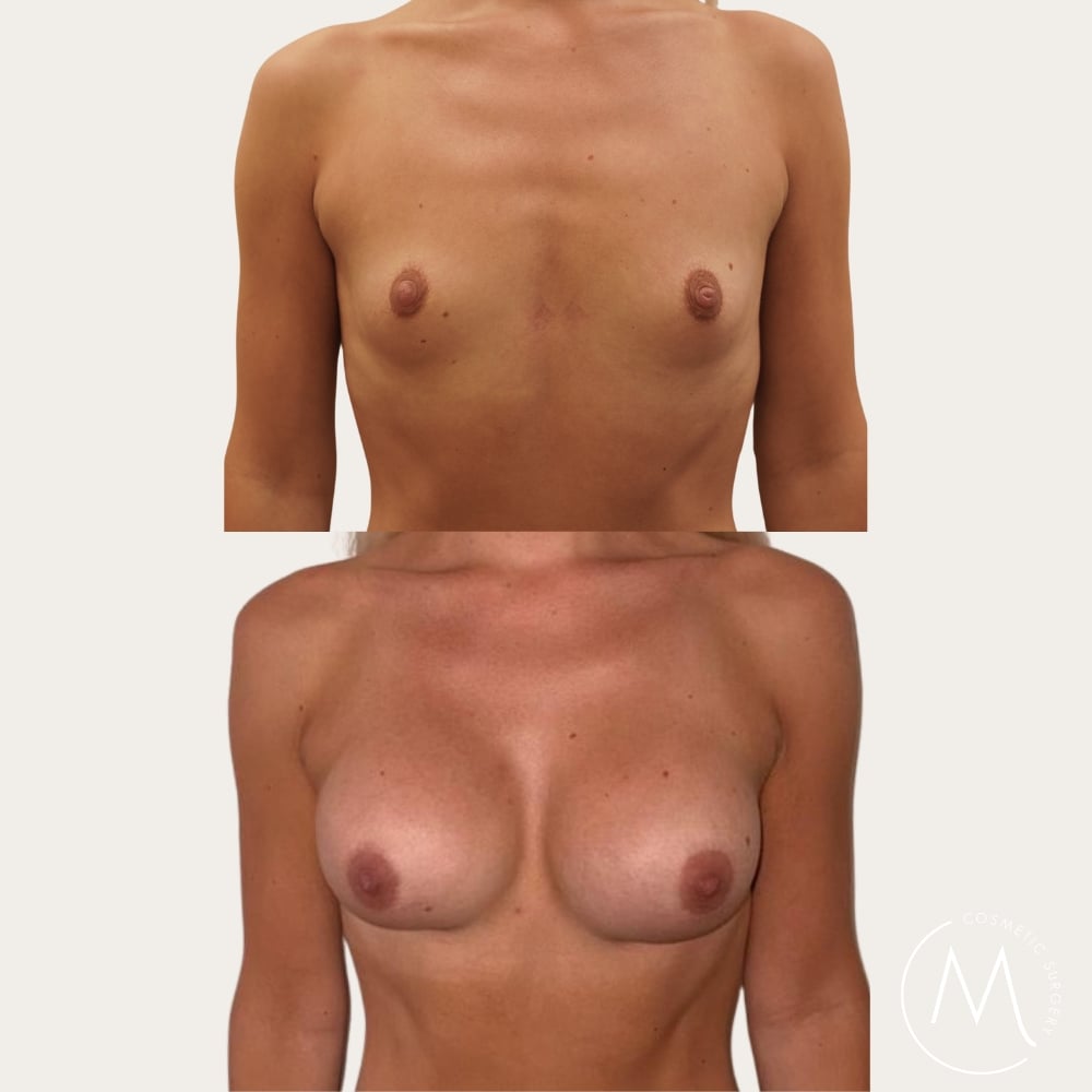 Before and after picture of breast augmentation patient