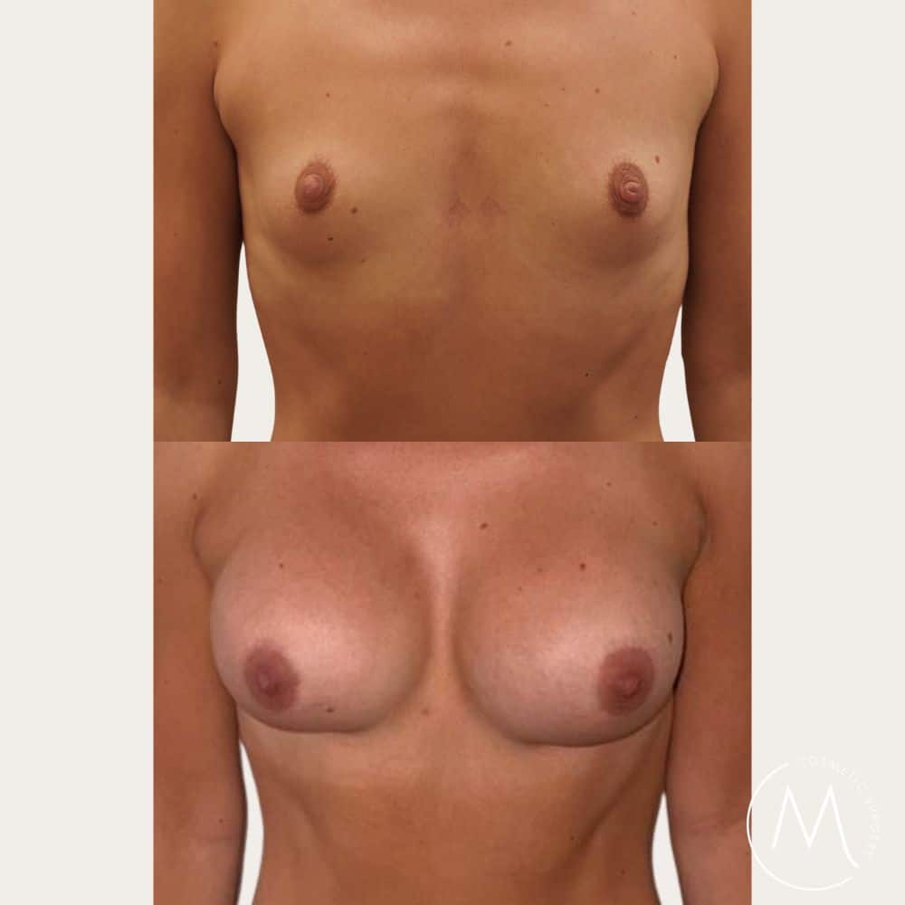 Before and after picture of breast augmentation patient
