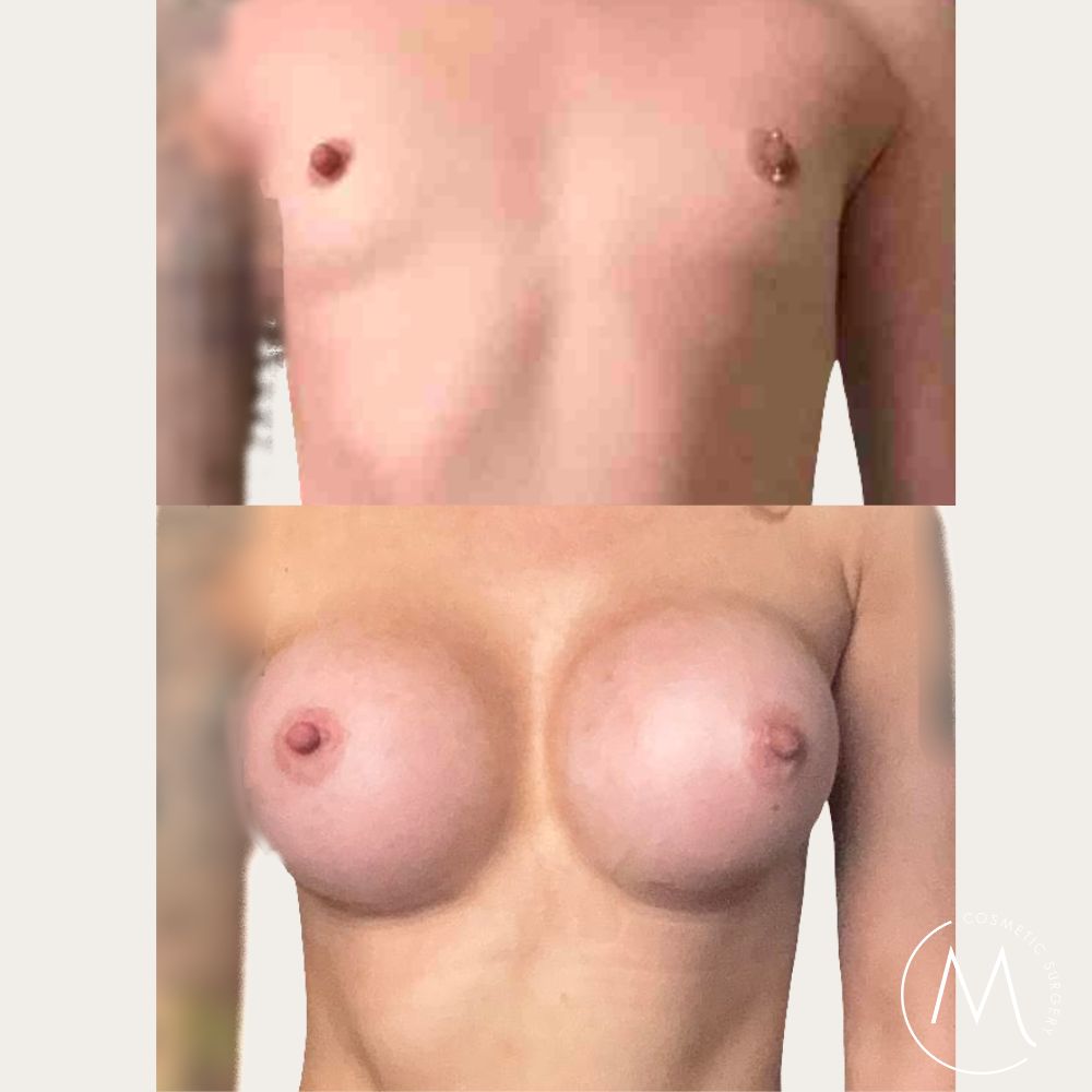 Before and after picture of breast augmentation patient
