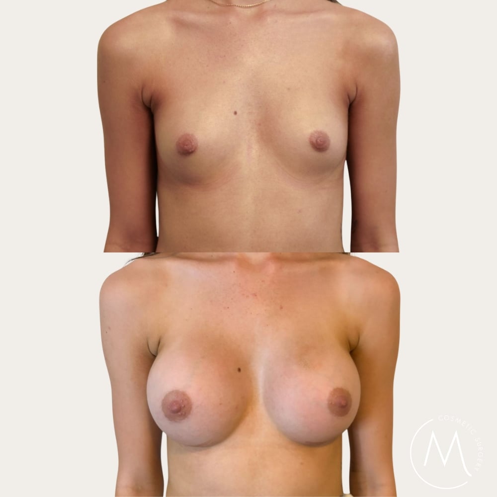 Before and after picture of breast augmentation patient from Adelaide