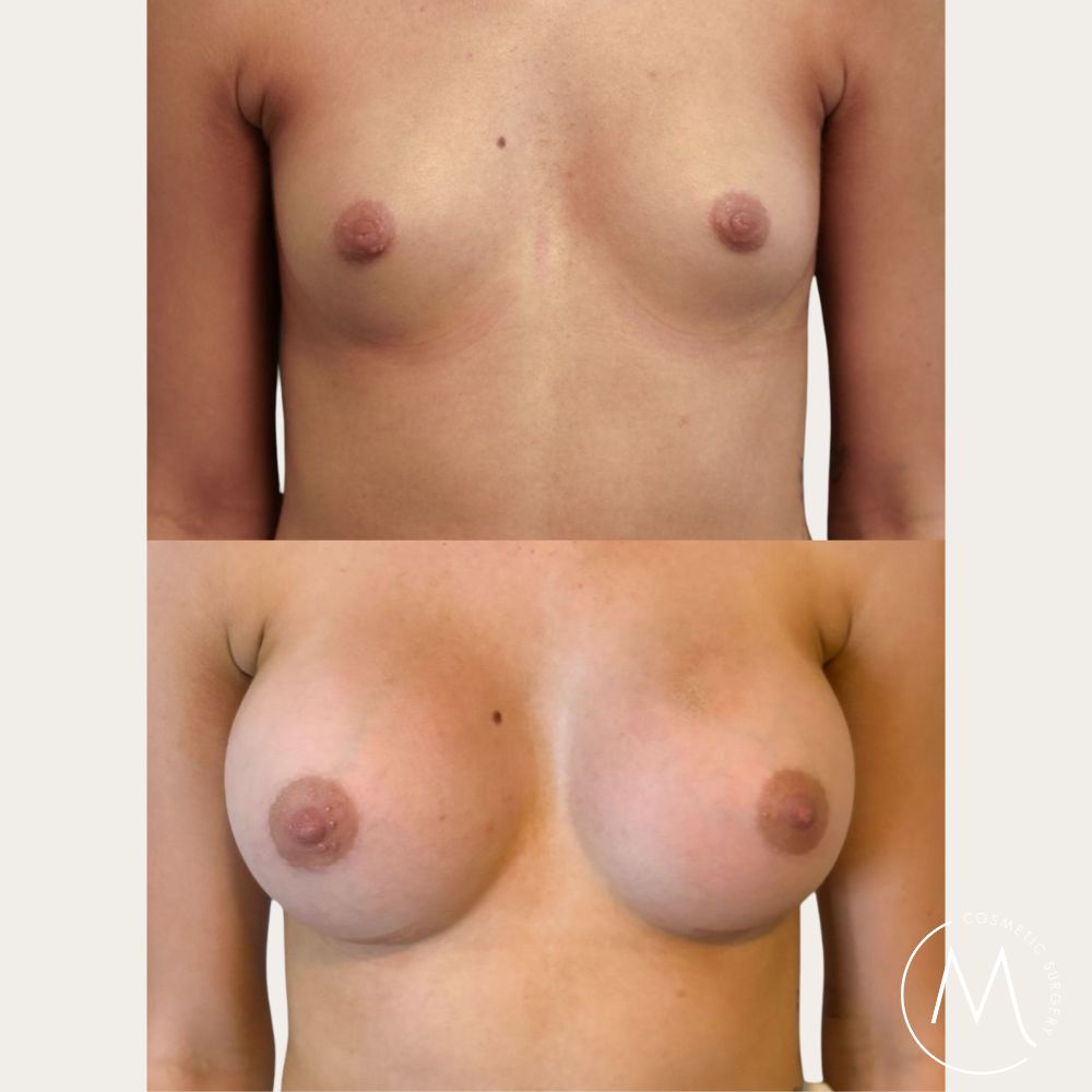 Before and after picture of breast augmentation patient