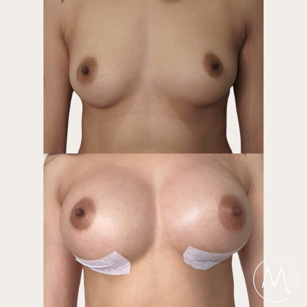 Before and after picture of breast augmentation patient