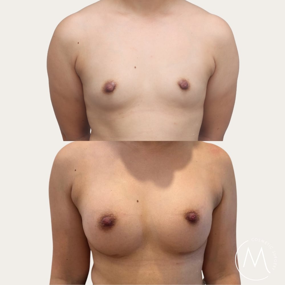 Before and after picture of breast augmentation patient