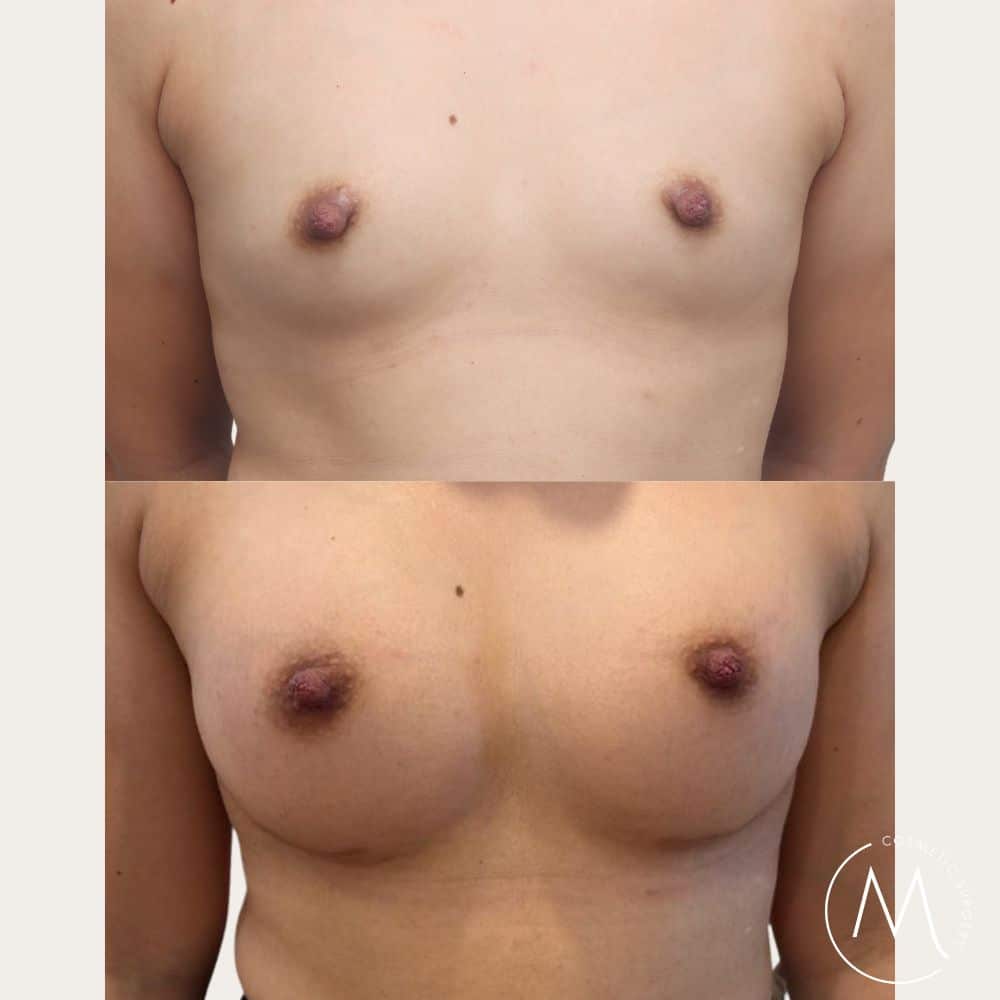 Before and after picture of breast augmentation patient