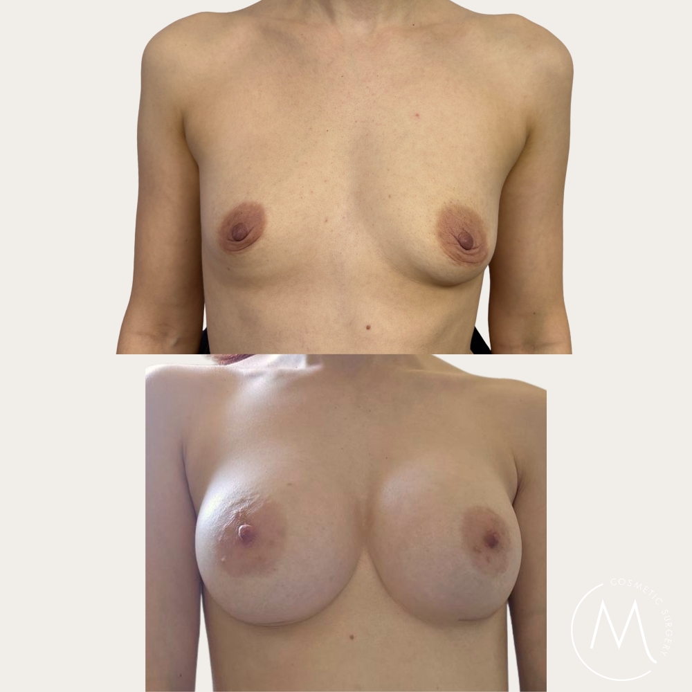 Before and after picture of breast augmentation patient