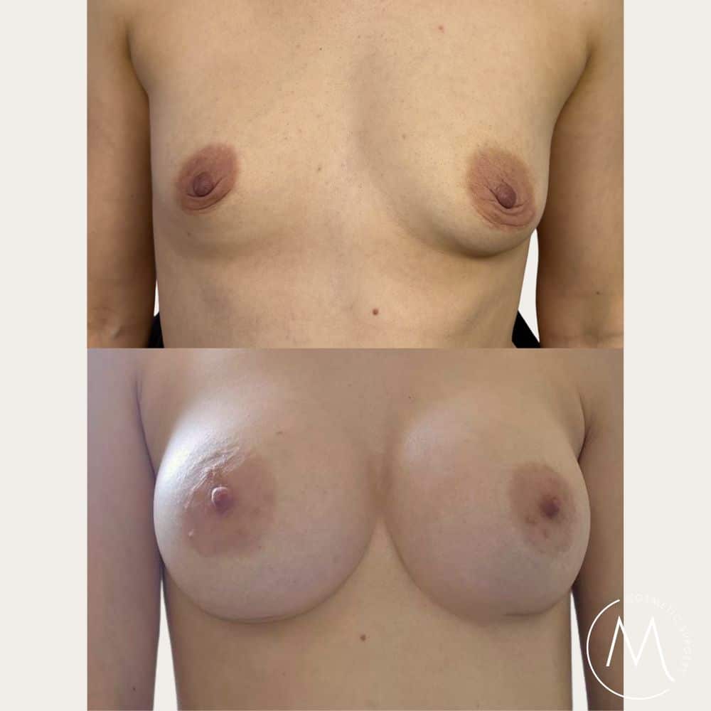 Before and after picture of breast augmentation patient