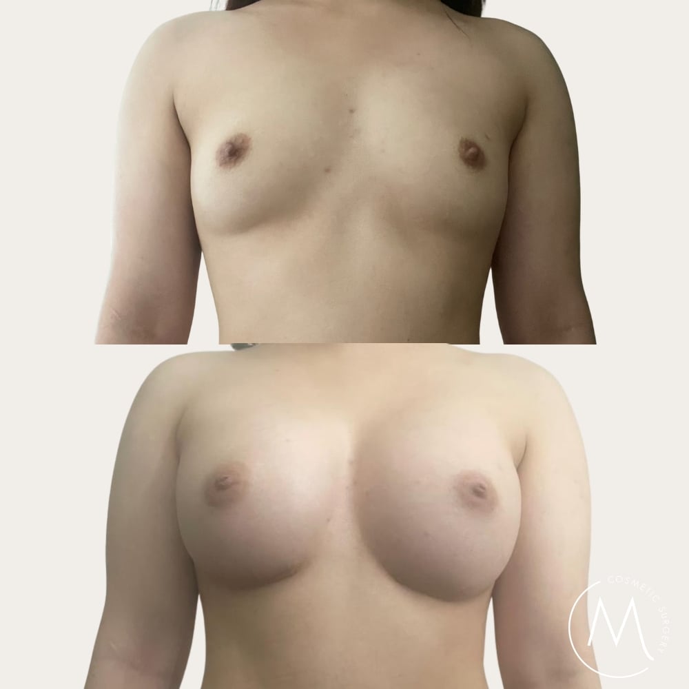 Before and after picture of breast augmentation patient