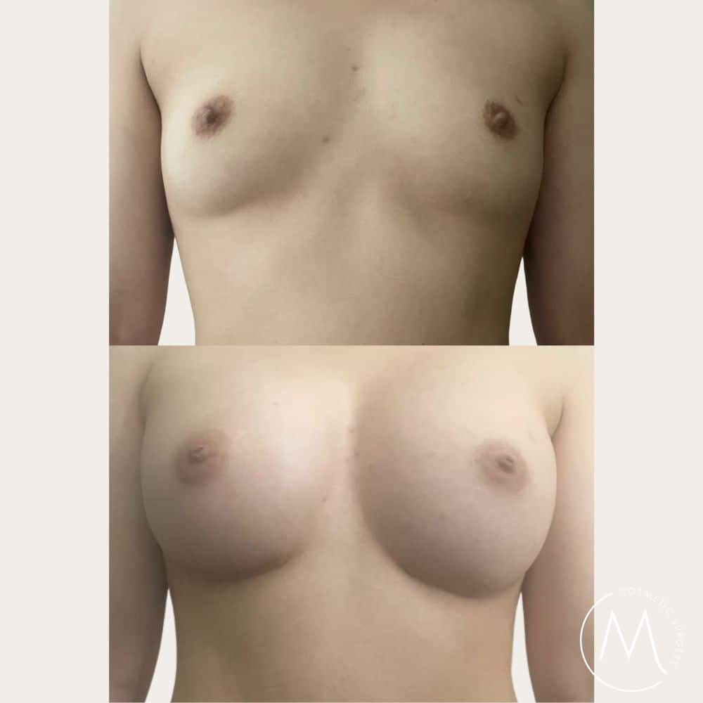 Before and after picture of breast augmentation patient