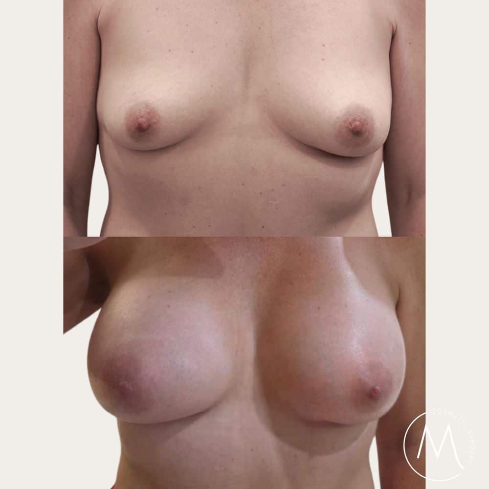 Before and after picture of breast augmentation patient