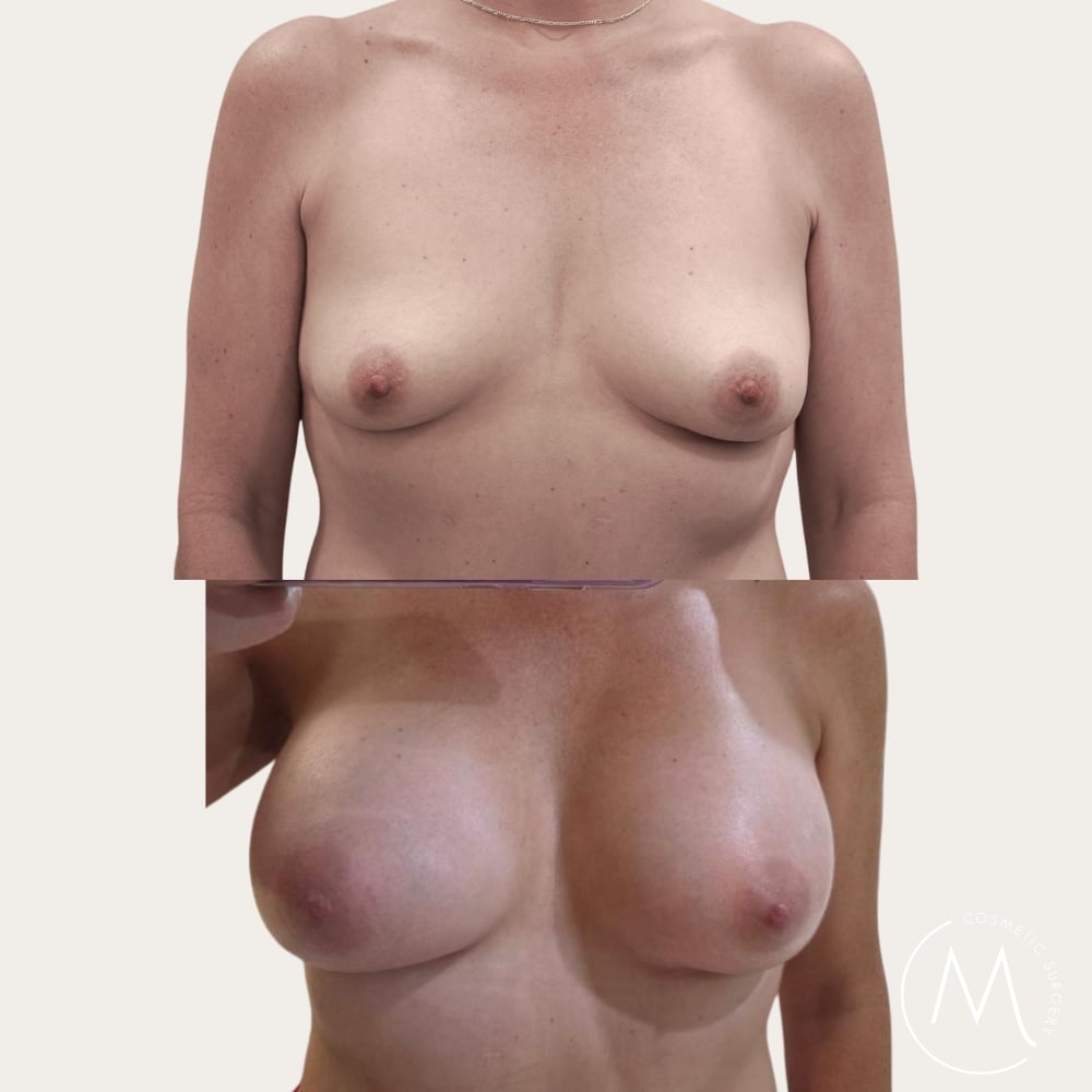 Before and after picture of breast augmentation patient