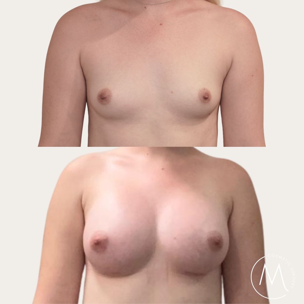 Before and after picture of breast augmentation patient