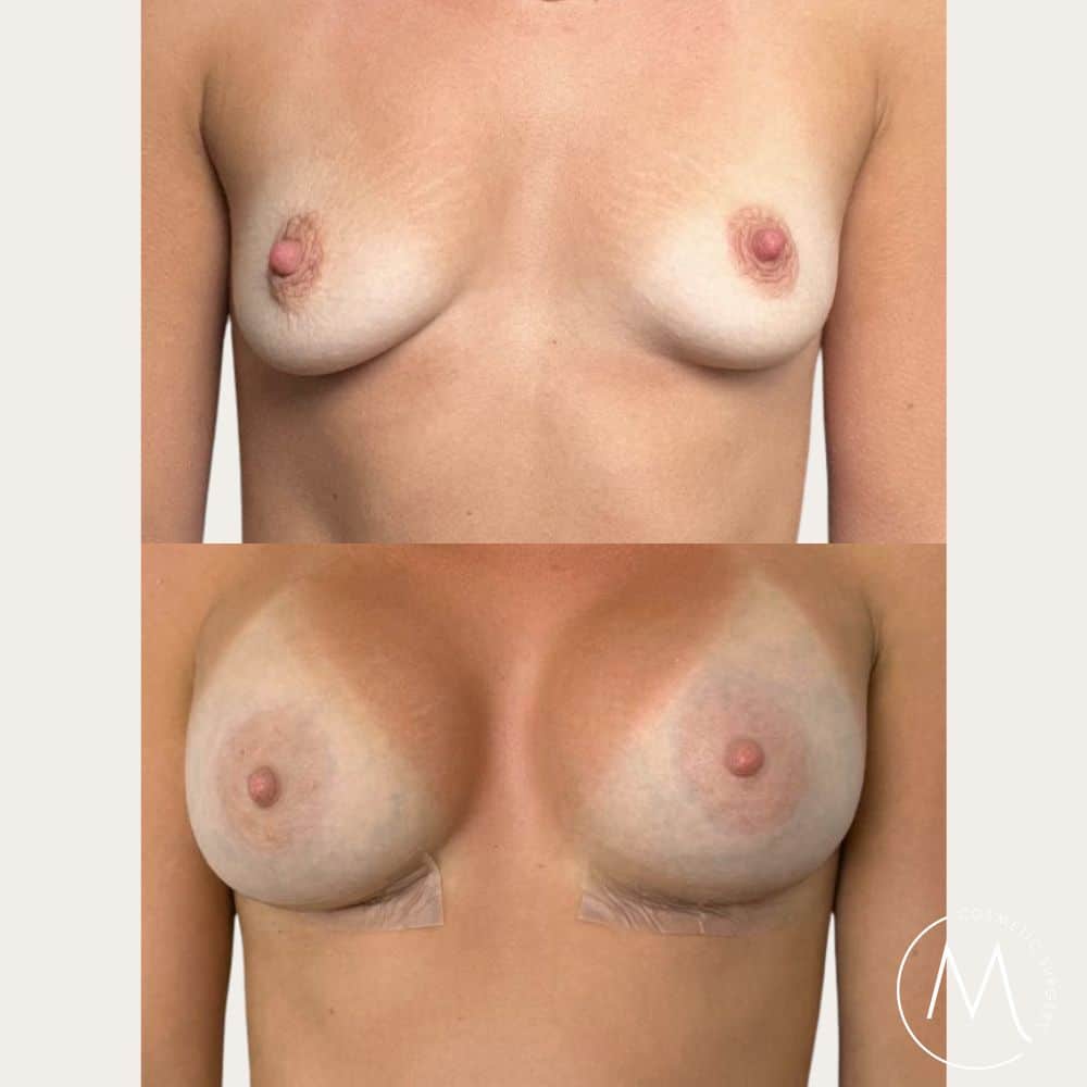 Before and after picture of breast augmentation + wedge technique patient